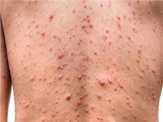الكونغو الديمقراطية تسجل 4779 حالة إصابة بـ جدري القردة 1 IMG 20240827 121917 874