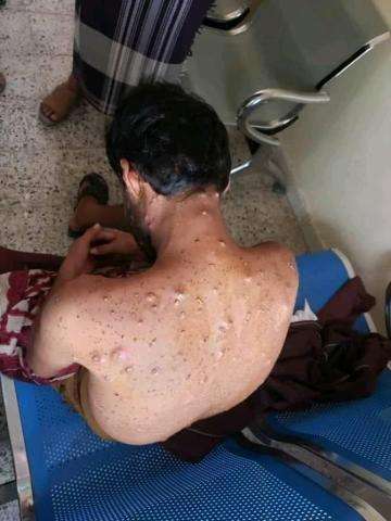 تحذير صحي .. ظهور فيروس جديد في اليمن يهدد الصحة العامة 1 6742e2e4d8ec3