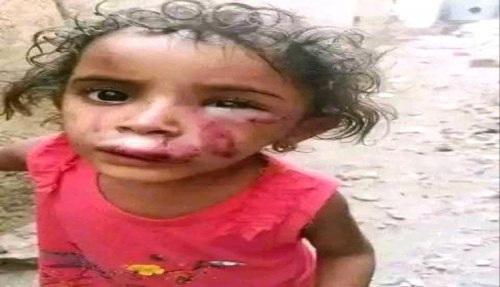 أم تعذب طفلتها بوحشية في تعز بعد اتهامها بفقدان الذهب 1 6037352871797834512