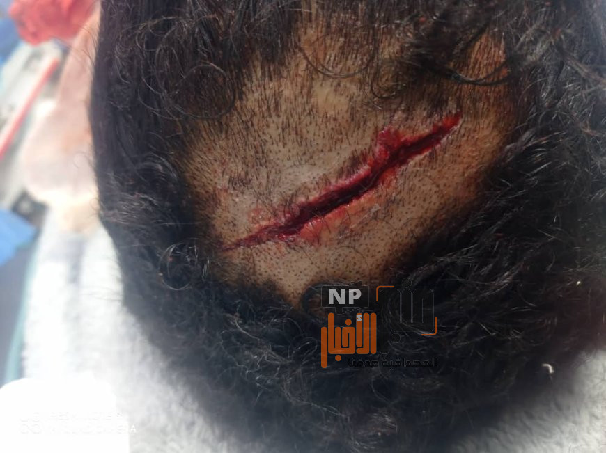 شاهد صورة.. إصابة بالغة يتعرض لها بائع قات في لحج (بسبب لا يصدق) 1