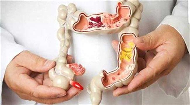 5 مشروبات صحية تحميك من سرطان القولون 1 04449f4e 89d2 4336 8110 049a61964dae 1