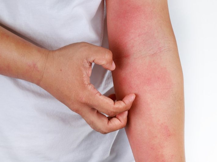 الإكزيما الأعراض الأسباب والعلاج