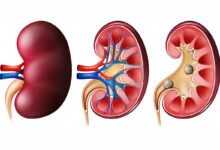kidney stone2