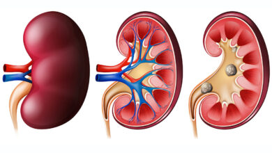 kidney stone2