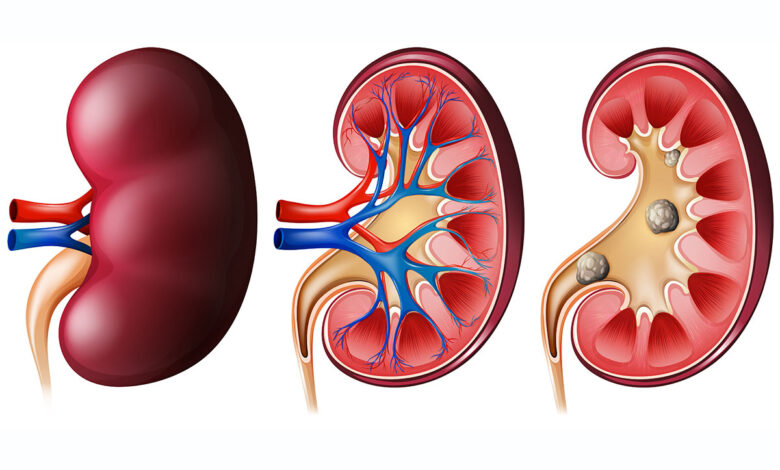 علاج الكلى في بيتك .. إليك ما لا يخبرك به الصيادلة 1 kidney stone2