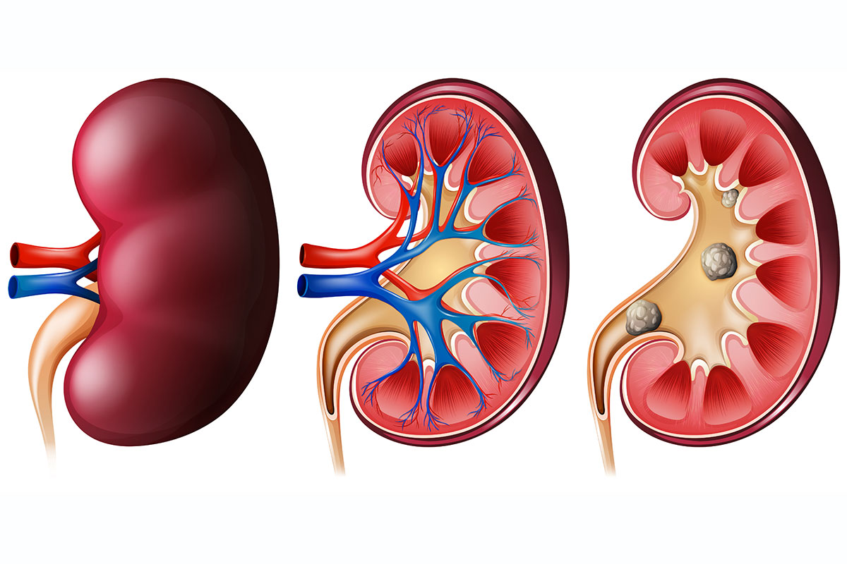 kidney stone2