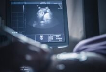 واقعة طبية نادرة .. سيدة مصرية حامل بـ9 أجنة ( تفاصيل ) 6 202511131145191815A