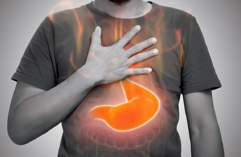 أسباب غير متوقعة لحرقة المعدة قد تصيبك يوميًا 1 6985e68c4236042b7b5f82a5