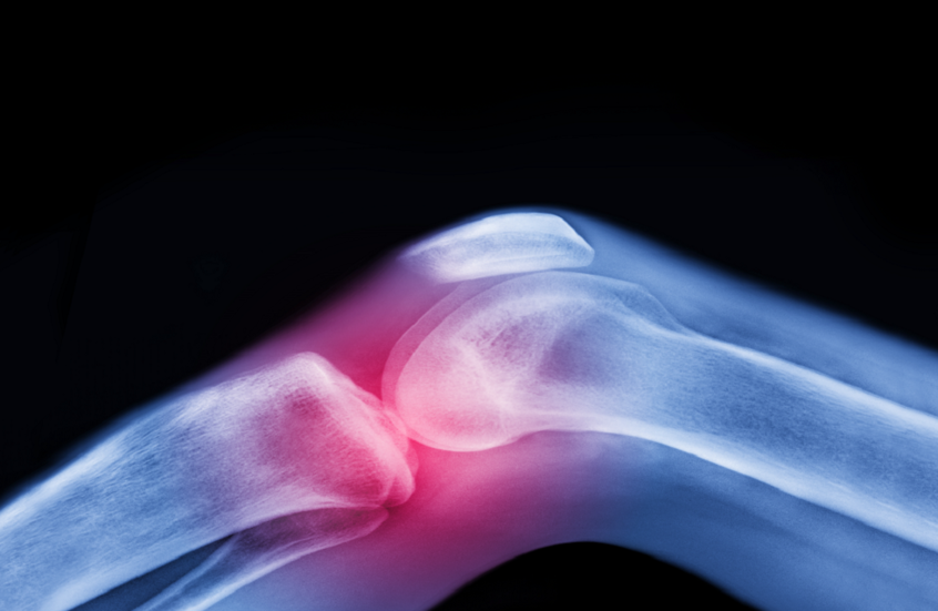 ابتكار ثوري .. ركبة بشرية حية قد تنهي معاناة آلام المفاصل 1 69d63da24c59b74d083cbb7e